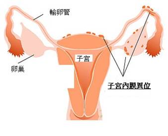 子宫内膜异位症常见症状有哪些