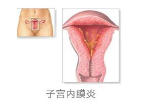 什么是子宫内膜炎